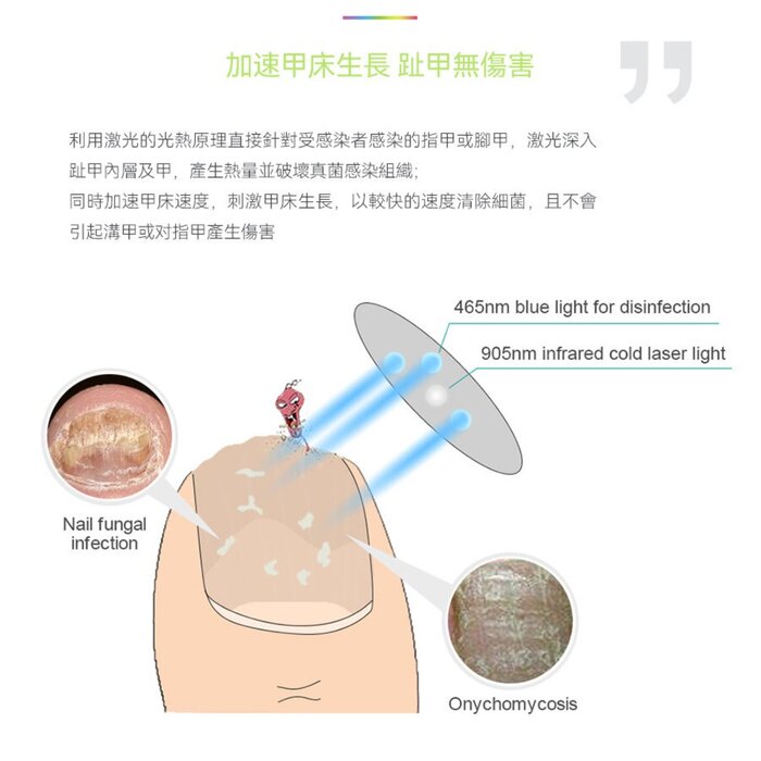 Newedo Onychomycosis Laser Therapy Device HZJ-01  Product Thumbnail